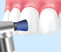 PMTC（Professional Mechanical Tooth Cleaning）